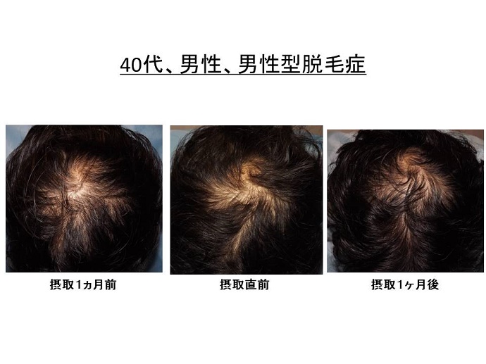 円形脱毛症　病院""
